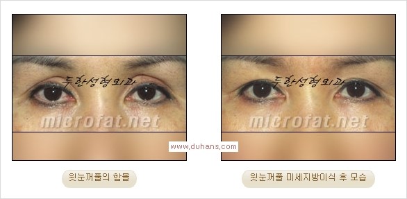 [두한성형외과 Dr. 컬럼] - [눈꺼풀의 지방이식] 관련 이미지 1