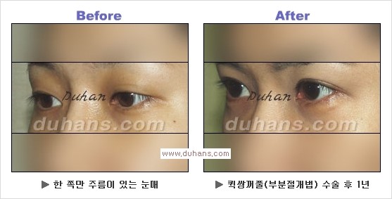 ​[두한성형외과 경쟁력 눈성형] - [자연스러운면서 매력적인 쌍꺼풀 퀵 쌍꺼풀 수술 안내] 관련 이미지 22