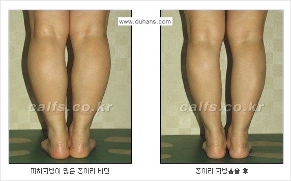 ⁠⁠[두한성형외과 경쟁력 멀티종아리성형] - [지방흡입이 필요한 종아리 비만 안내] 관련 이미지 7