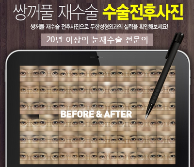 [Duhan Plastic Surgery Double Eyelid Revision Surgery] - [Ptosis, sausage eyelids] image 33