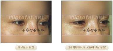 두한성형외과 눈밑성형 - 애교필러 후 눈밑재수술 관련 이미지 20