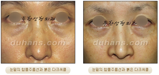 두한성형외과 눈밑성형 - 눈밑지방제거, 눈밑주름, 눈밑지방재배치 관련 이미지 55