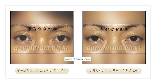 [두한성형외과 경쟁력 눈성형] - [풀린 쌍꺼풀 라인 재수술의 여러 가지 방법 안내] 관련 이미지 12