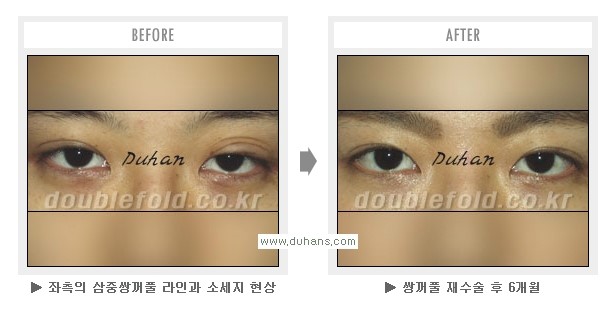 [두한성형외과 Dr. 컬럼] - [쌍꺼풀 재수술(눈 재수술)의 목적] 관련 이미지 9