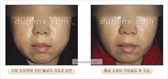 [두한성형외과 경쟁력 지방흡입] - [볼살, 턱선의 간편 지방흡입] 관련 이미지 24