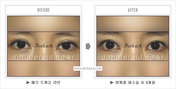 [두한성형외과 경쟁력 눈성형] - [쌍꺼풀 재수술 과정과 쌍꺼풀 재수술 실패의 원인, 쌍꺼풀 재수술의 성공 요건] 관련 이미지 12