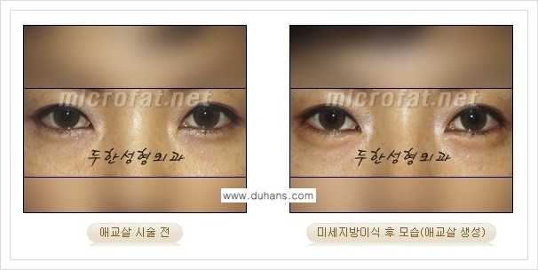 [두한성형외과 경쟁력 눈밑성형] - [애교살과 다크써클과의 관계] 관련 이미지 7