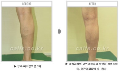 [종아리 두한성형외과] - [나에게 맞는 종아리시술] 관련 이미지 63