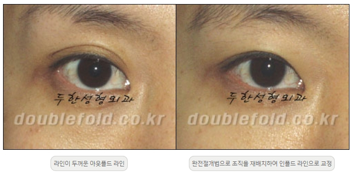 [Double Eyelid Surgery Duhan Plastic Surgery] - [Revision Methods] image 7