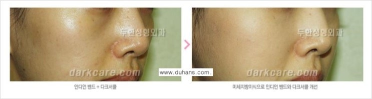 [두한성형외과 무한 경쟁력 다크써클 치료] - [다크써클 + 인디언밴드 콤비 프로그램] 관련 이미지 3