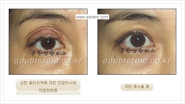 [두한성형외과 경쟁력 쌍꺼풀 재수술] - [극한의 상태에서 쌍꺼풀 재수술 안내 ①] 관련 이미지 9
