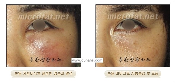 ​[두한성형외과 가을엔 지방흡입을] - [볼살, 눈밑, 턱선 초음파 미세지방흡입] 관련 이미지 8
