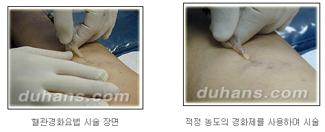 [두한성형외과 정맥류] - [하지정맥류, 정맥확장증, 혈관확장증] 관련 이미지 50