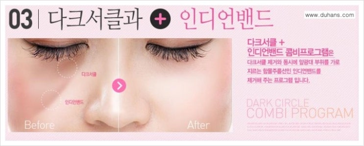 [두한성형외과 무한 경쟁력 다크써클 치료] - [다크써클 + 인디언밴드(앞광대주름) 콤비 프로그램] 관련 이미지 1