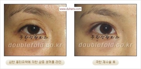 ​[두한성형외과 눈재수술] - [앞트임복원, 뒤트임복원, 쌍꺼풀복원] 관련 이미지 23