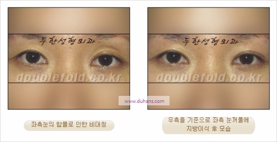 [두한성형외과 경쟁력 눈성형] - [비대칭 쌍꺼풀 라인의 여러 가지 교정 방법] 관련 이미지 22
