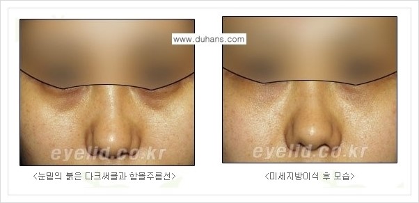 [두한성형외과 경쟁력 눈밑성형] - [다크써클 수술 안내 2.] 관련 이미지 9