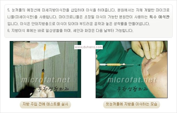 [두한성형외과 Dr. 컬럼] - [미세지방이식의 유용성] 관련 이미지 4