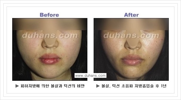 ​​[두한성형외과 경쟁력 지방흡입] - [아름다운 얼굴 윤곽선을 위한  볼살지방흡입, 턱선지방흡입 안내] 관련 이미지 18