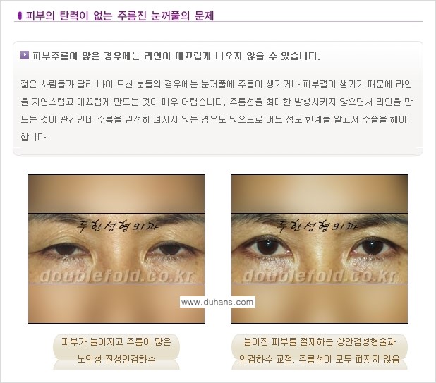[두한성형외과 극한 재수술, 쌍꺼풀 재수술] - [쌍꺼풀 재수술에서 극복해야 할 극한의 상황과 문제] 관련 이미지 8