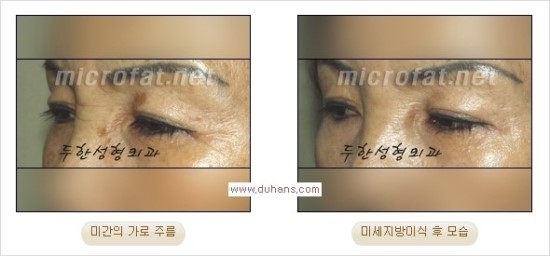 [두한성형외과 경쟁력 주름성형] - [세월의 흔적! 주름을 교정하는 여러 가지 교정 방법] 관련 이미지 16