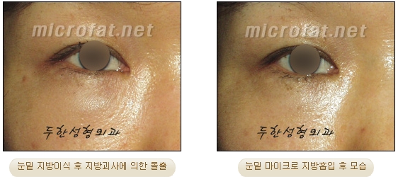 [Duhan Plastic Surgery Liposuction] - [Facial Liposuction] image 31