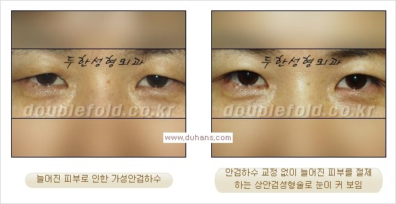 [두한성형외과 경쟁력 쌍꺼풀 재수술, 극한 눈재수술] - [안검하수(졸린 눈매)의 종류 안내] 관련 이미지 8