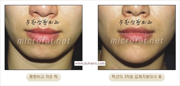 [두한성형외과 경쟁력 미세지방이식] - [부드럽고 아름다운 얼굴윤곽선 턱(하악부) 미세지방이식 안내] 관련 이미지 15