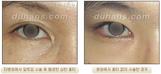 [Duhan Plastic Surgery Double Eyelid Surgery] - [Types of Double Eyelid Surgery] image 29