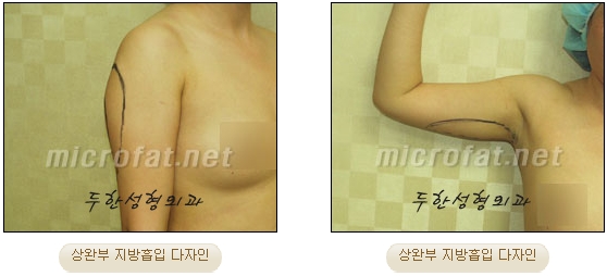 두한성형외과 지방흡입 - 부위별 안전 지방흡입 관련 이미지 7