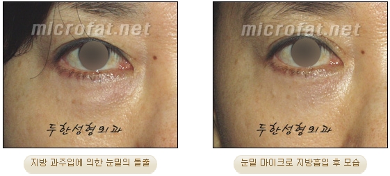 [Duhan Plastic Surgery Liposuction] - [Facial Liposuction] image 20
