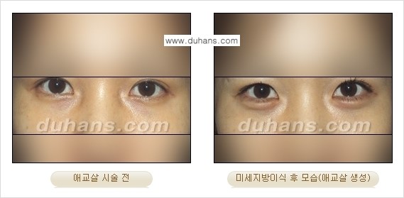 [두한성형외과 경쟁력 미세지방이식] - [눈밑 애교살을 위한 미세지방이식 1.] 관련 이미지 8