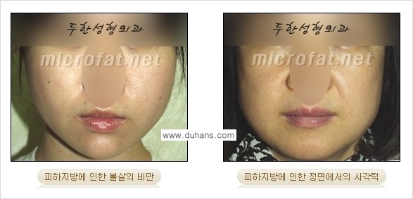 [두한성형외과 경쟁력 지방흡입] - [얼굴 지방흡입 부작용 교정방법 안내] 관련 이미지 2