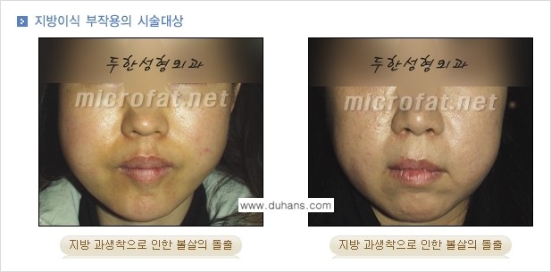 [두한성형외과 "미세지방이식"] - [지방이식 부작용 교정 정보 ①] 관련 이미지 3
