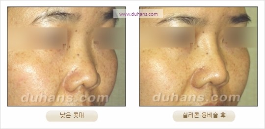 [두한성형외과 경쟁력 코성형 리더] - [자연스럽고 오똑한 콧망울! 코성형 방법]​ 관련 이미지 16