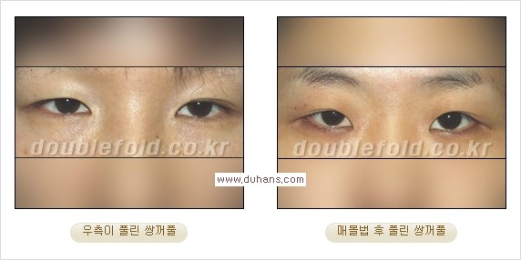 [두한성형외과 경쟁력 눈성형] - [풀린 쌍꺼풀 라인 재수술의 여러 가지 방법 안내] 관련 이미지 1