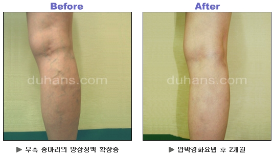 [두한성형외과 정맥류] - [하지정맥류, 정맥확장증, 혈관확장증] 관련 이미지 45