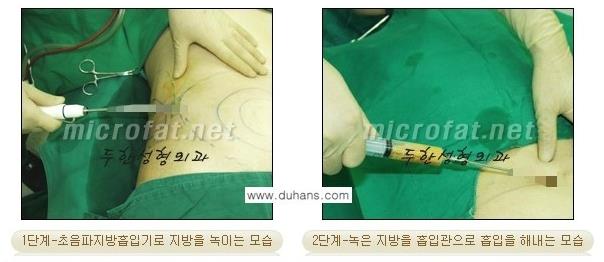 [두한성형외과 경쟁력 바디성형] - [아랫배, 윗배, 옆구리살, 허리살, 팔뚝살 지방흡입] 관련 이미지 7