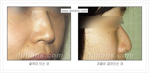 [두한성형외과 경쟁력 미세지방이식] - [자연스러운 코높임 지방이식 안내 ①] 관련 이미지 5