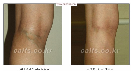 [두한성형외과 경쟁력 종아리성형 리더] - [종아리 성형 안내] 관련 이미지 22