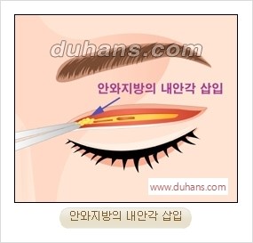 [두한성형외과 경쟁력 눈성형] - [완전절개법(Full incision method)의 재수술 과정] 관련 이미지 6