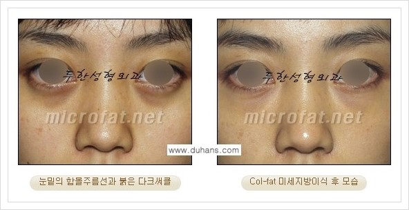 [두한성형외과 경쟁력 눈밑성형] - [눈밑 다크써클과 눈밑 함몰주름의 최적화 교정방법 안내] 관련 이미지 10