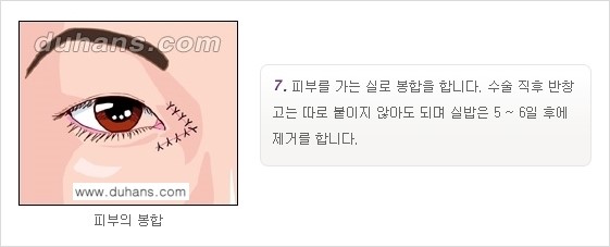 [두한성형외과 NO.1 눈성형] - [몽고주름 제거(앞트임 수술) 2.] 관련 이미지 8