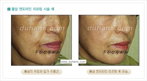 [두한성형외과 경쟁력 주름성형] - [엔도타인 리프팅 안내 ②] 관련 이미지 1