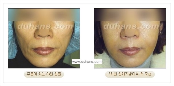 [두한성형외과 경쟁력 얼굴미세지방이식] - [볼살지방이식, 이마지방이식, 측두부지방이식 안내] 관련 이미지 5