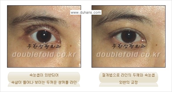 [두한성형외과 경쟁력 쌍꺼풀 재수술, 극한 눈재수술] - [쌍꺼풀 재수술 방법 - 속눈썹 외반] 관련 이미지 8