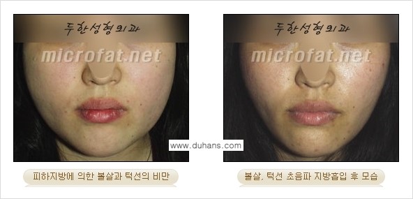 ​[두한성형외과 가을엔 지방흡입을] - [볼살, 눈밑, 턱선 초음파 미세지방흡입] 관련 이미지 7