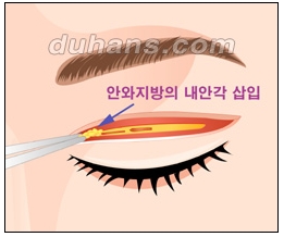 [Doohan Plastic Surgery Double Eyelid Revision Surgery] - [Double Eyelid Revision Surgery Process] image 22