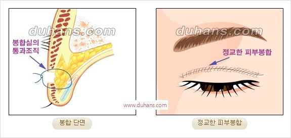 [두한성형외과 경쟁력 쌍꺼풀 재수술] - [쌍꺼풀 재수술 과정] 관련 이미지 66