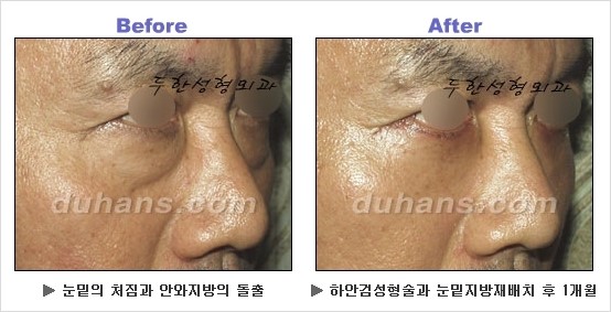 [두한성형외과 경쟁력 동안성형 리더] - ​[미간주름, 이마주름, 안검성형, 이마거상술, 눈썹거상술] 관련 이미지 99